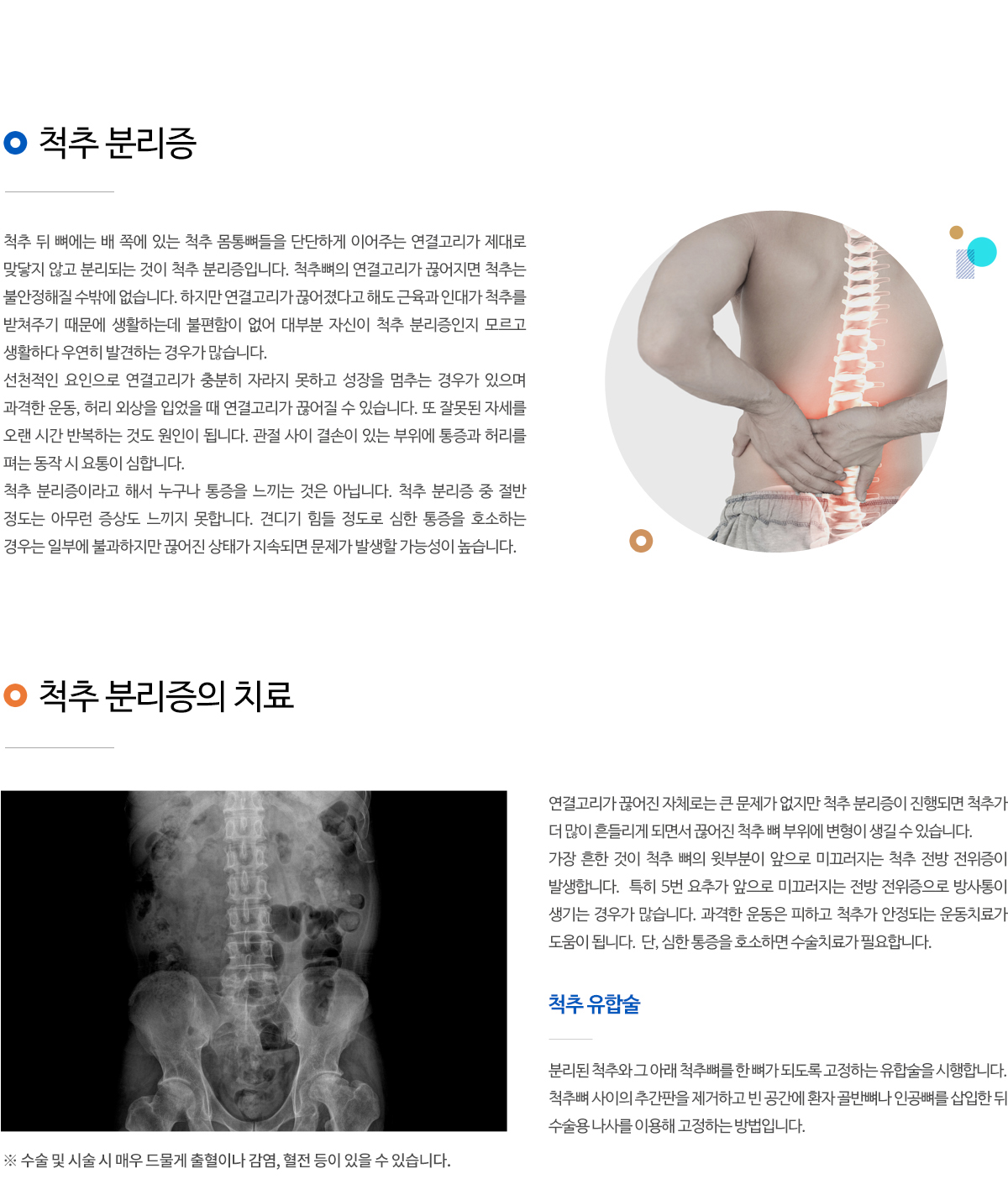 척추 분리증