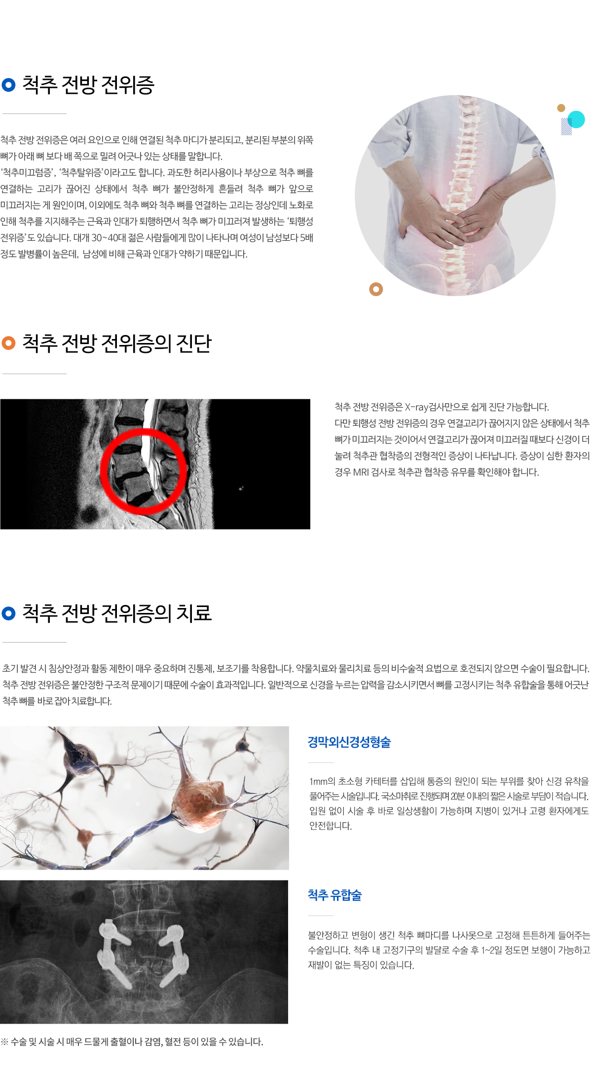 척추 전방 전위증