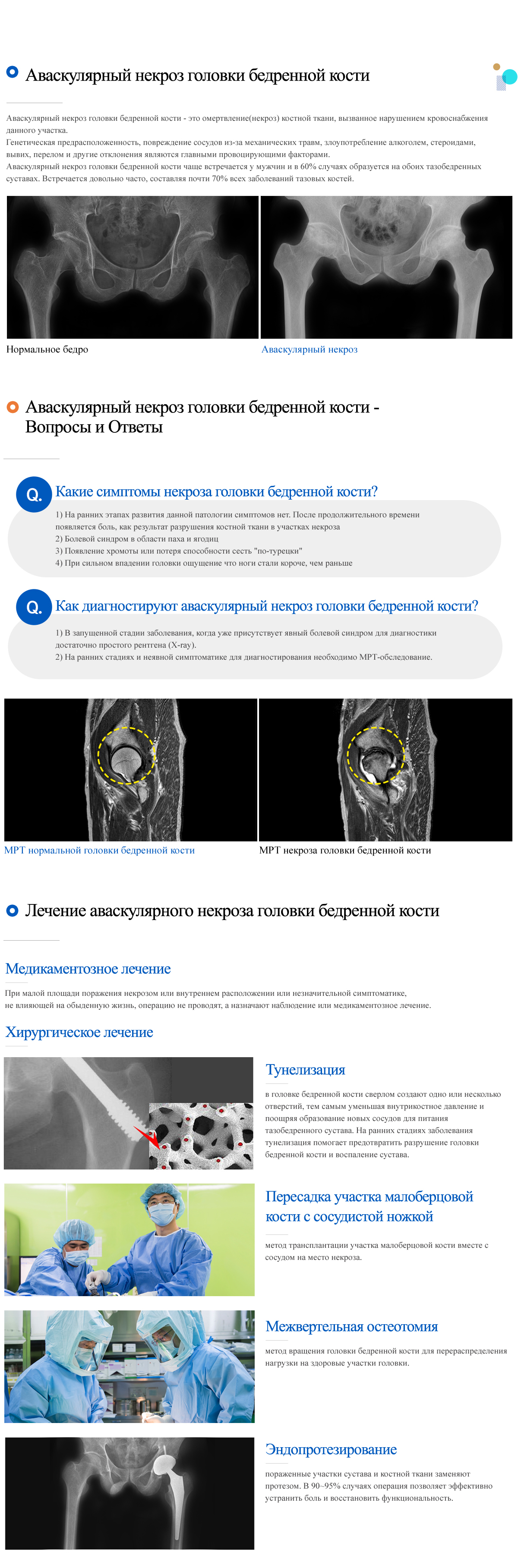 Avascular necrosis of the gemoral head