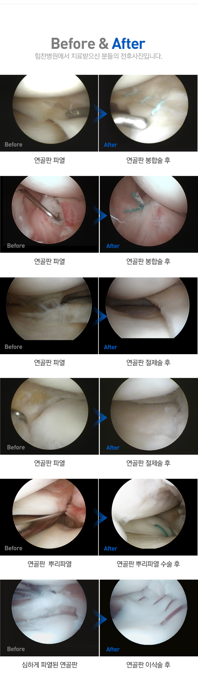 반월상 연골 손상