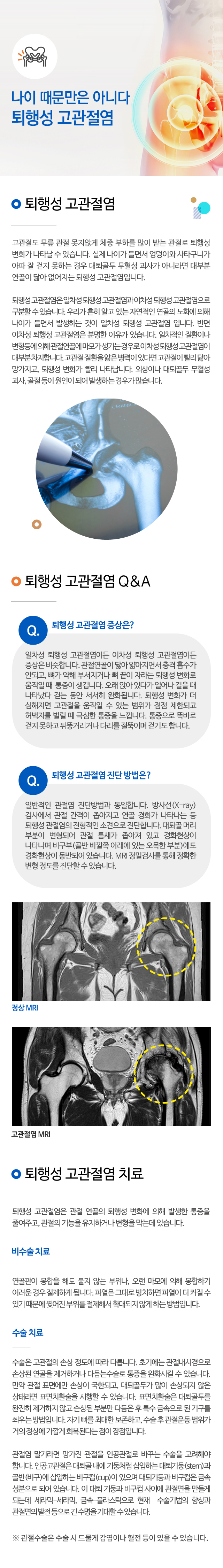 퇴행성 고관절염