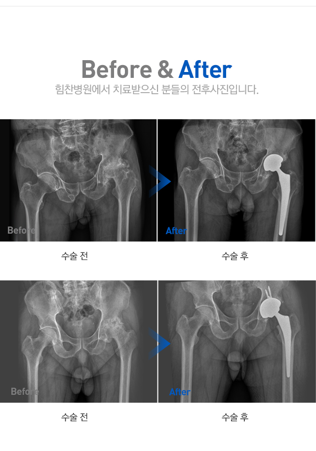 퇴행성 고관절염