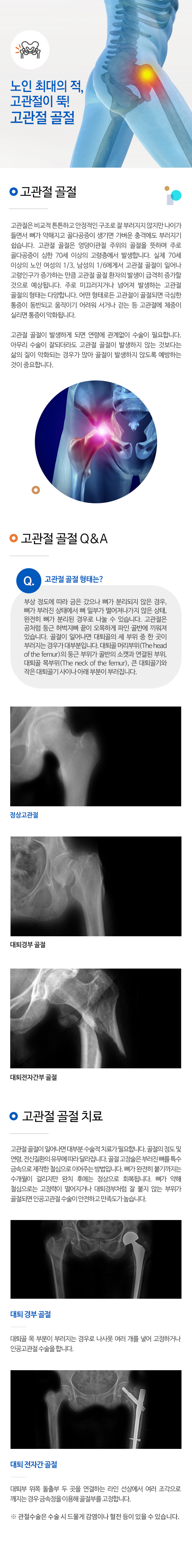 고관절 골절