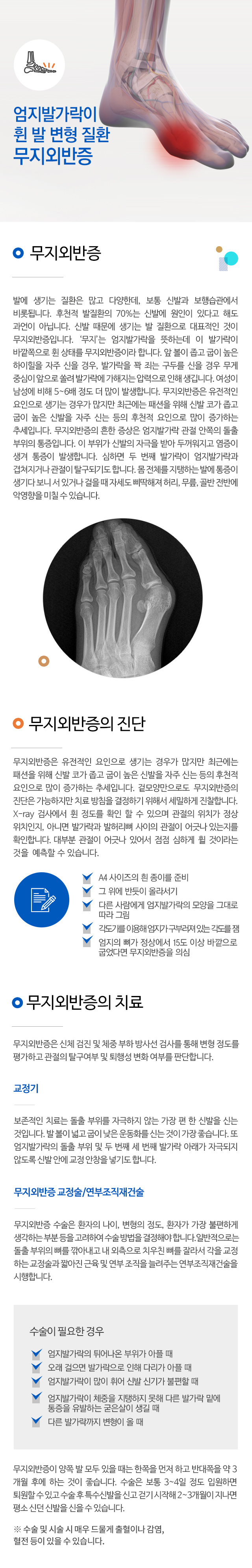 무지외반증