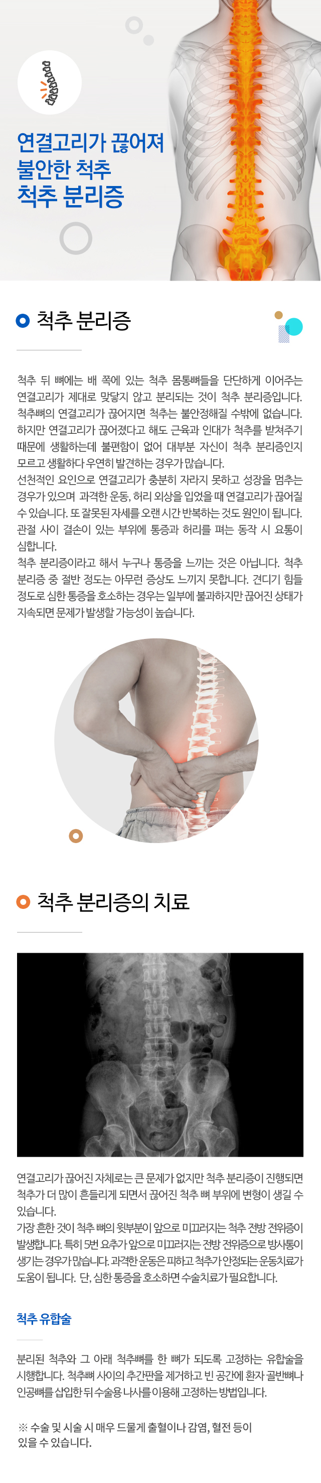 척추 분리증