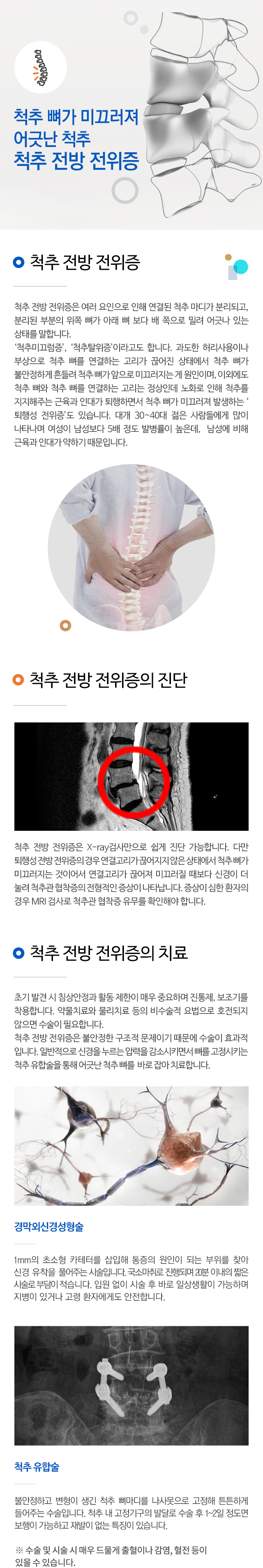 척추 전방 전위증