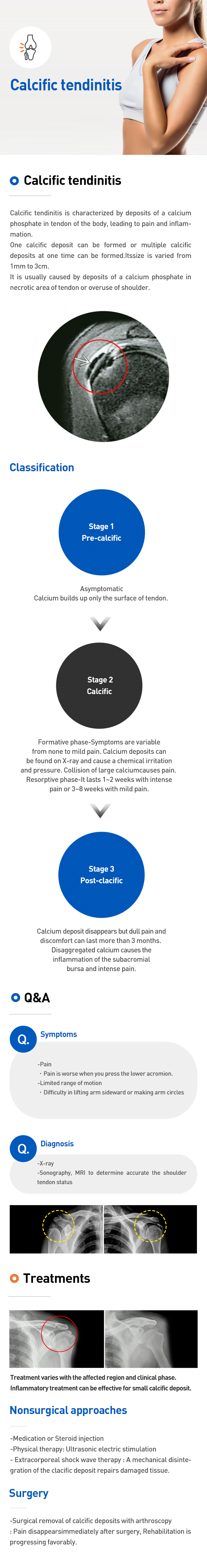 Calcific tendinitis