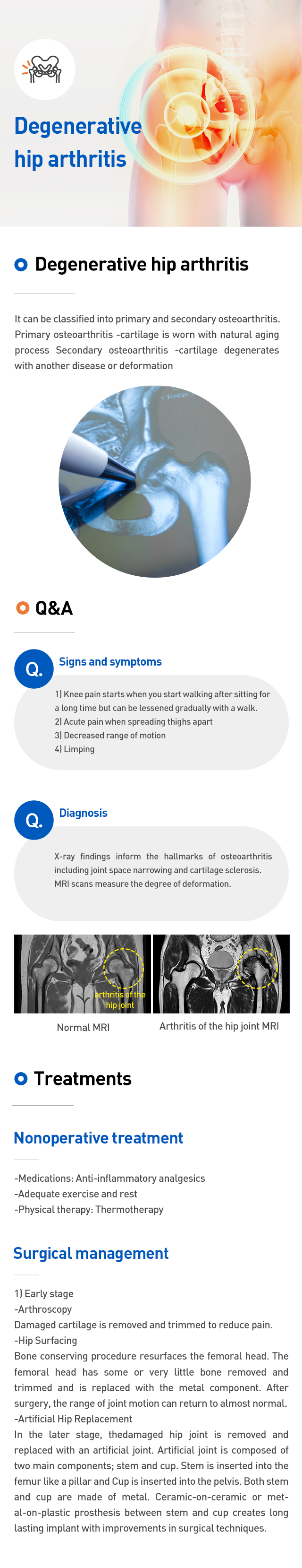 Degenerative hip arthritis