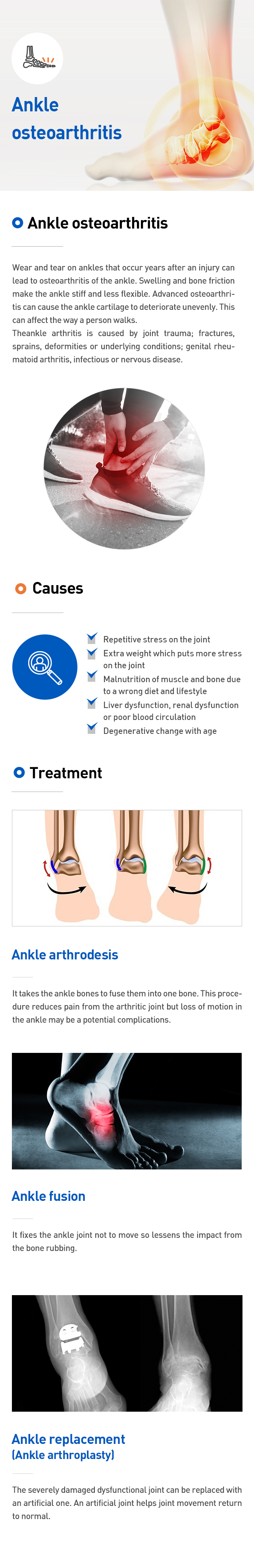 Ankle osteoarthritis