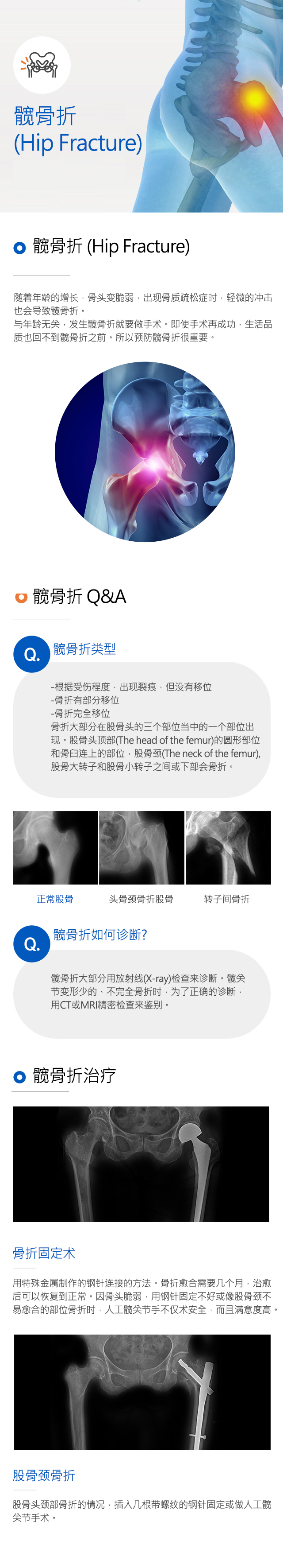 Hip fracture