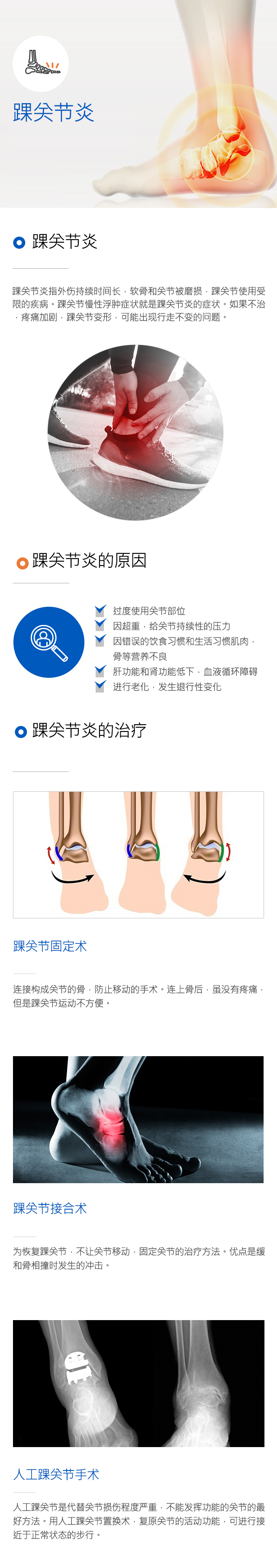 Ankle osteoarthritis