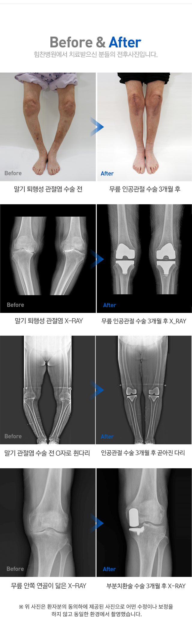 퇴행성 관절염