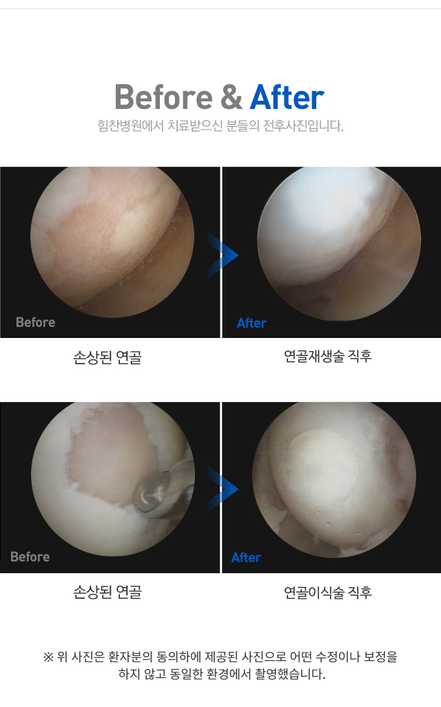 관절 연골 손상