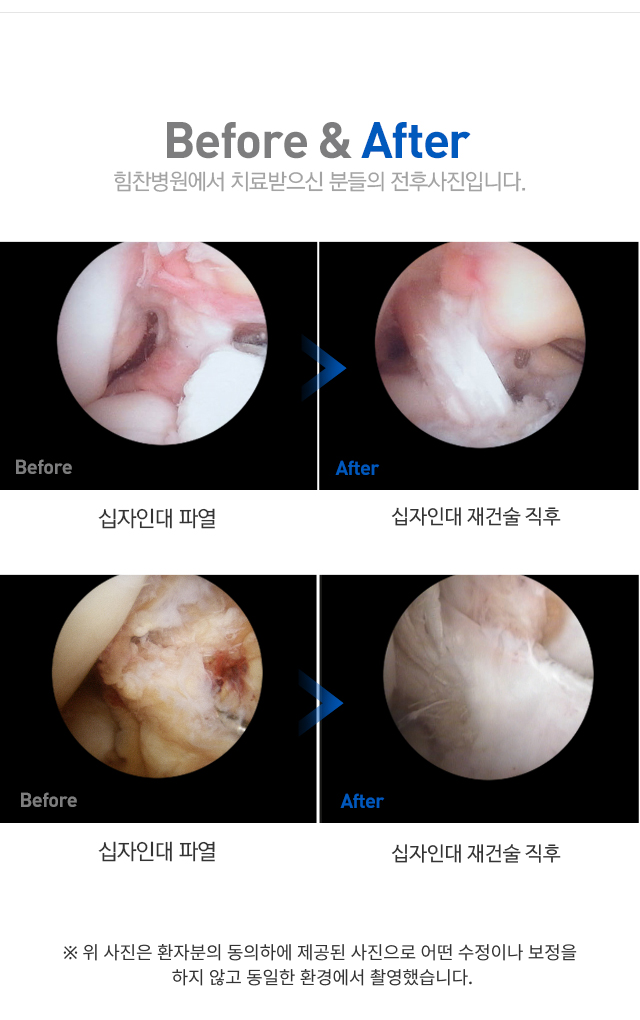 무릎 인대 손상