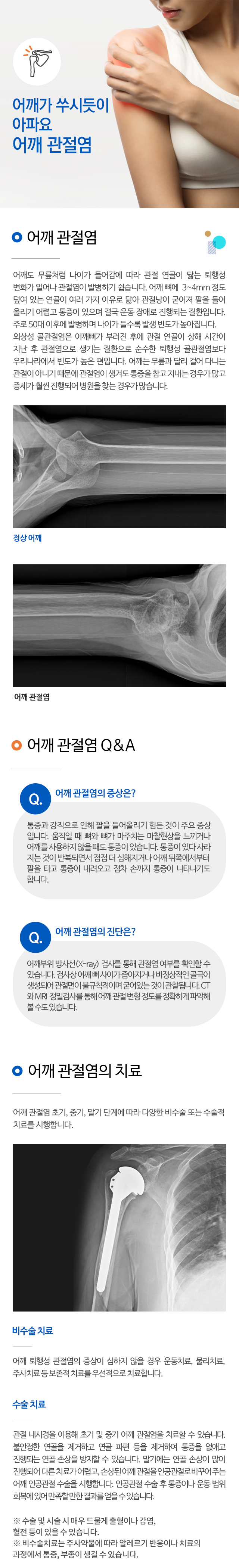 어깨 관절염