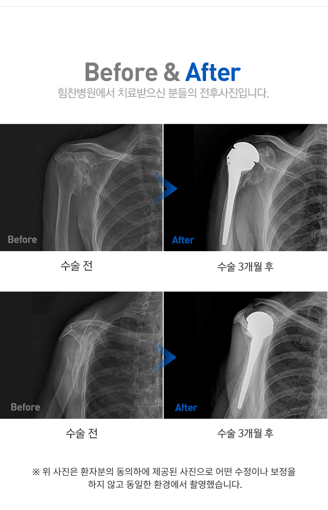 어깨 관절염