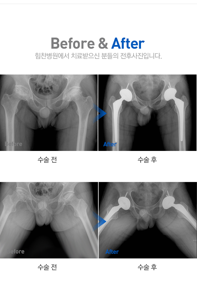 대퇴골두 무혈성 괴사