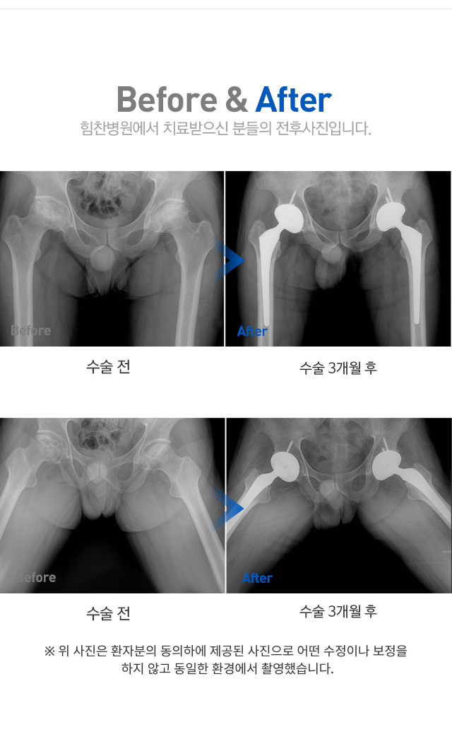 대퇴골두 무혈성 괴사