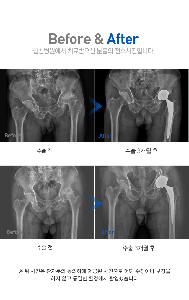 퇴행성 고관절염