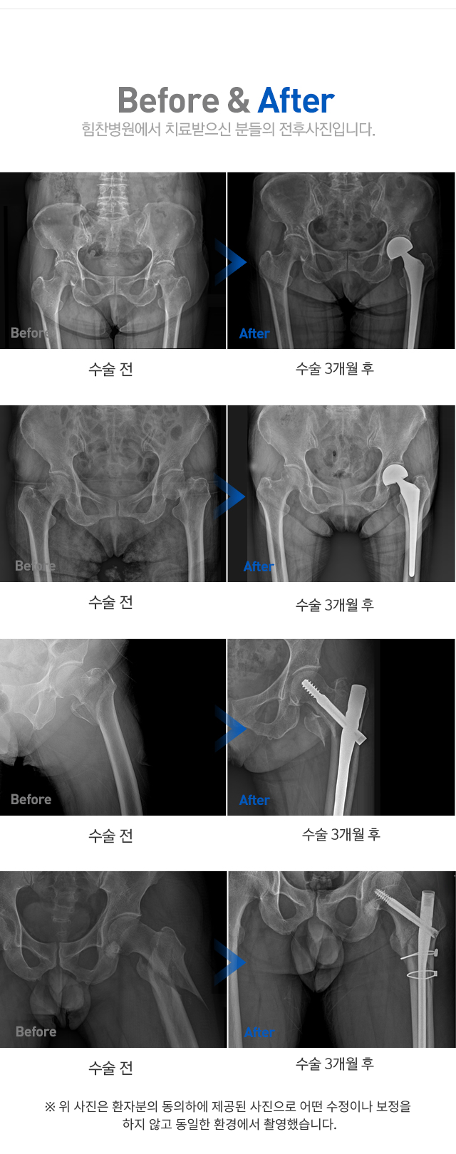 고관절 골절