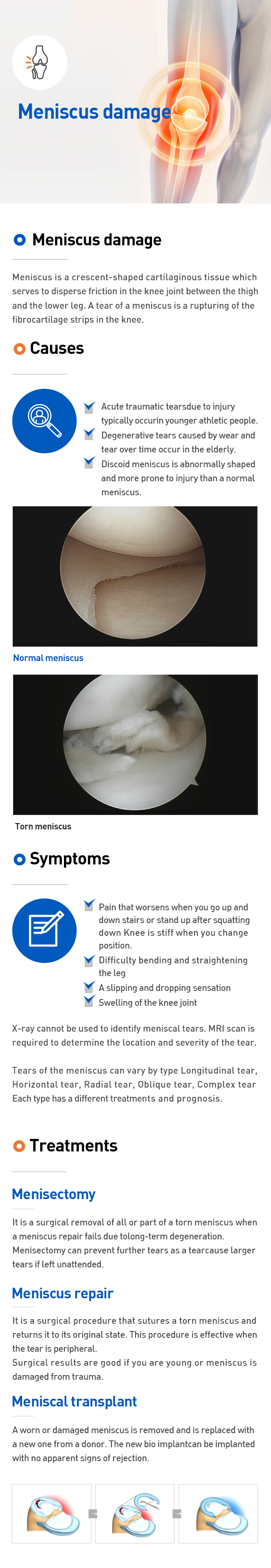 Meniscus damage