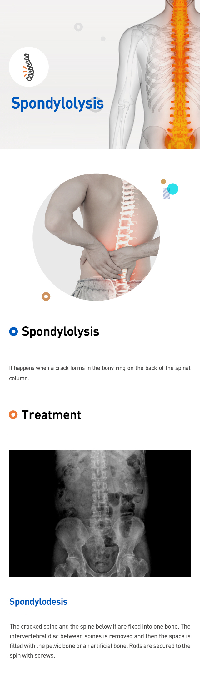 Spondylolysis