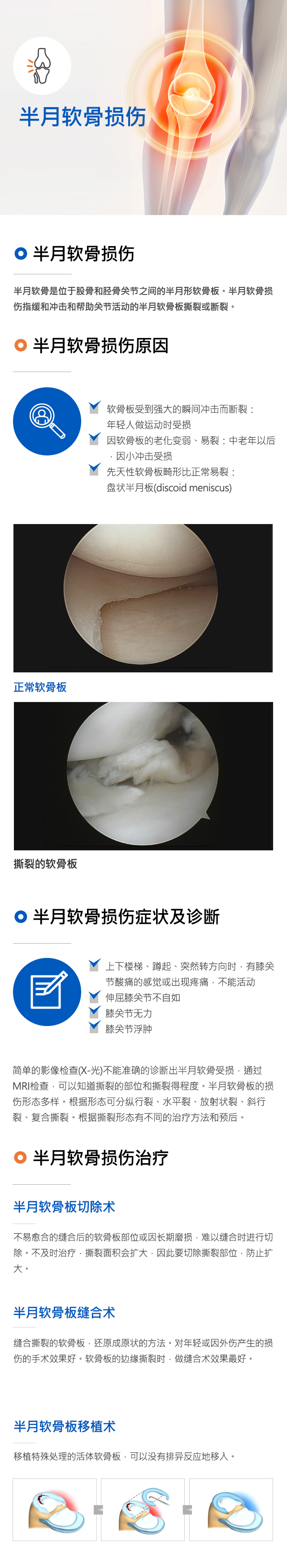 Meniscus damage