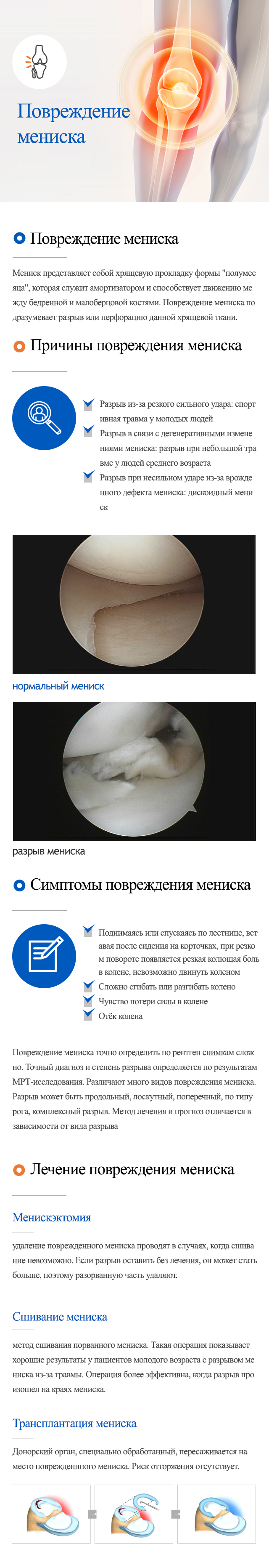 Суставные заболевания > Заболевания колена > Повреждение мениска