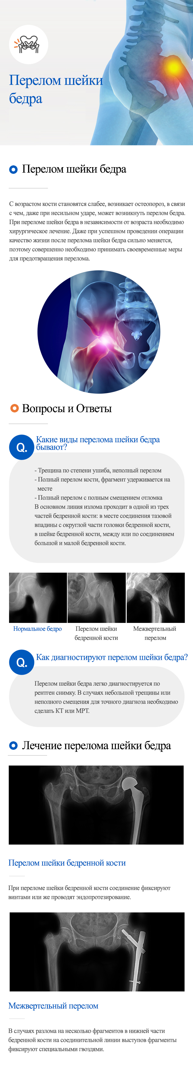 Суставные заболевания > Заболевание тазобедренного сустава > Перелом шейки  бедра