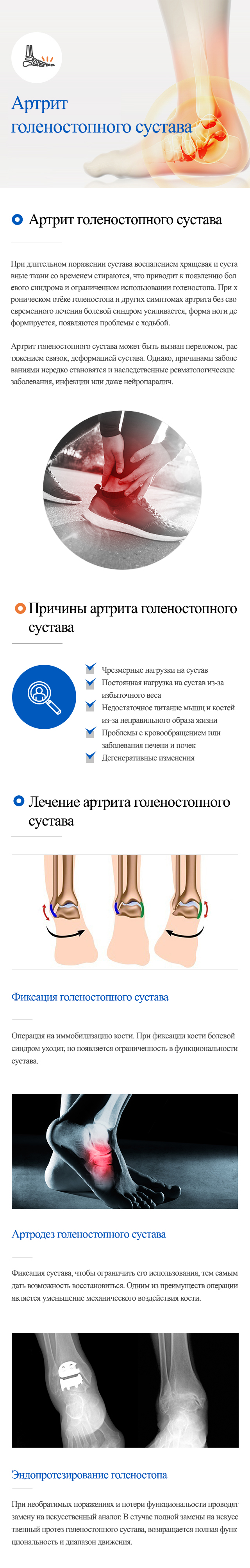 Суставные заболевания > ступни ног > Артрит голеностопного сустава