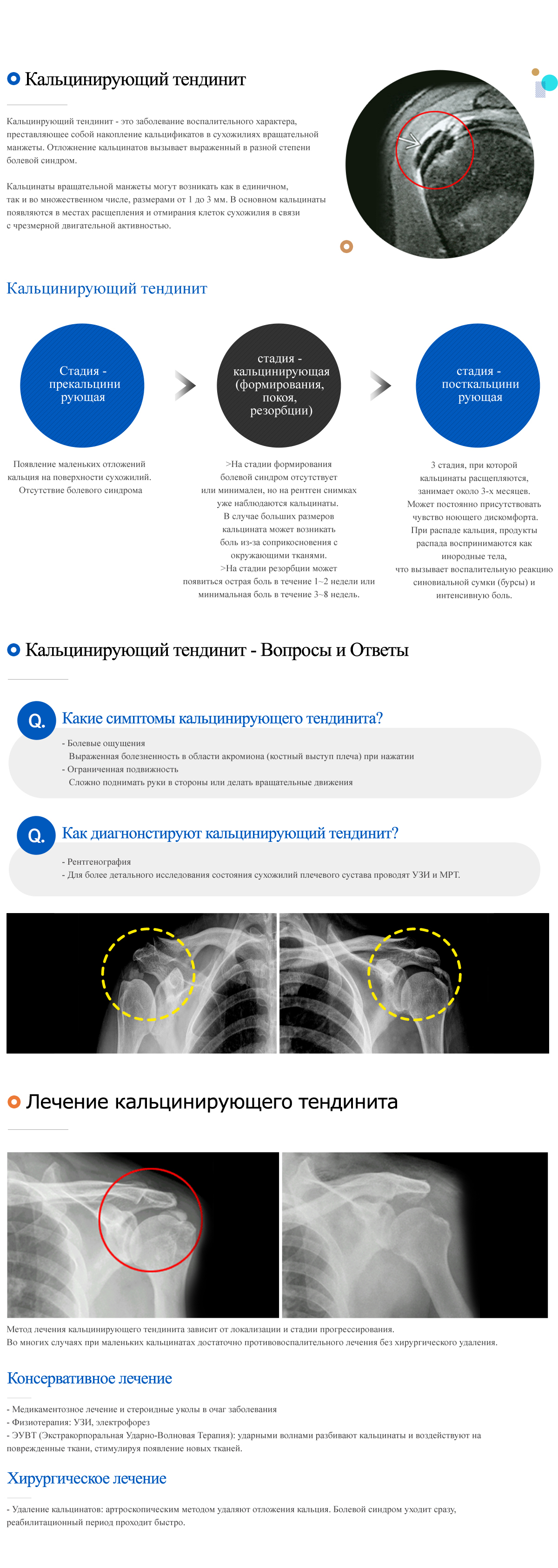 Calcific tendinitis