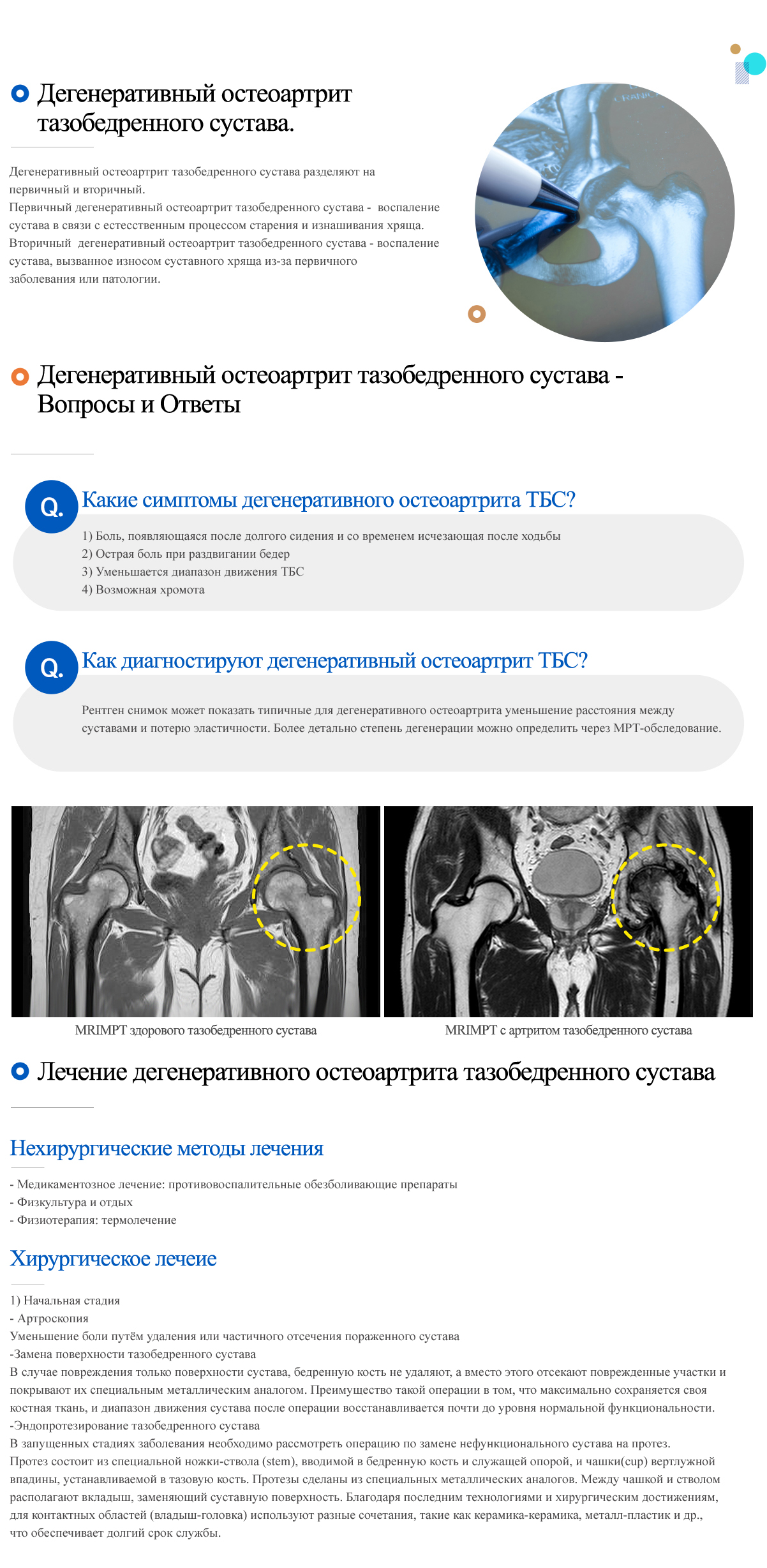 Degenerative hip arthritis